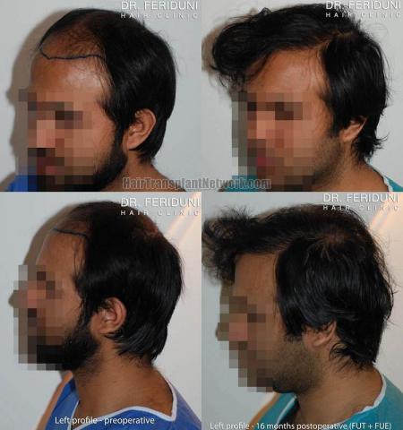 Hair transplantation surgery before and after images