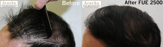 Hair transplantation surgery before and after pictures