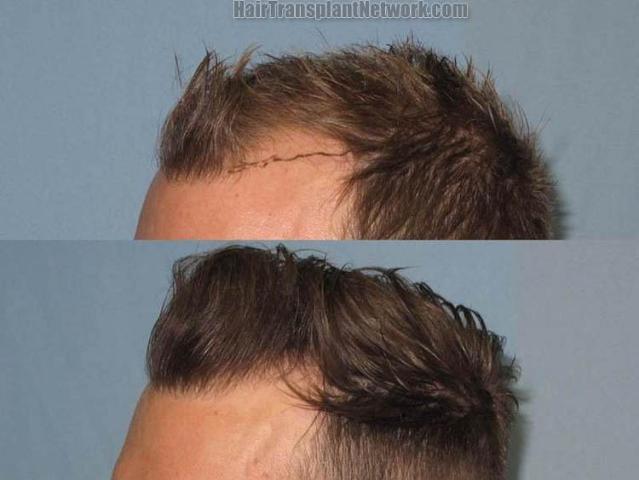 Hair transplantation surgery before and after photos