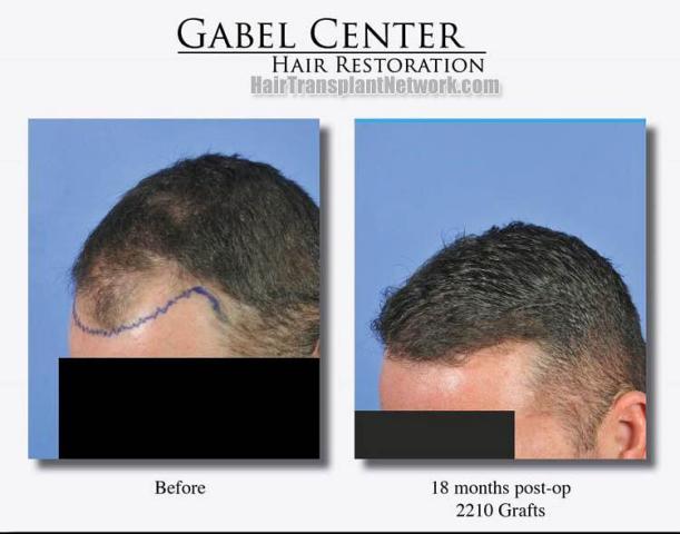 Hair restoration surgery before and after photos