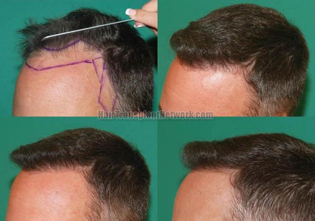 Hair transplantation surgery before and after photos