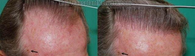 Comparison of left side before and after hair transplant