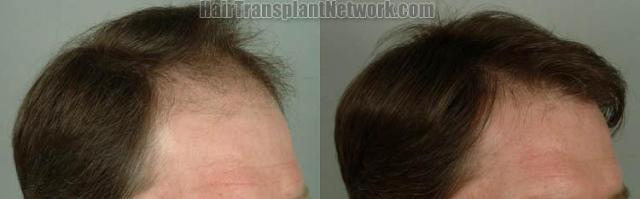 Hair restoration procedure before and after results