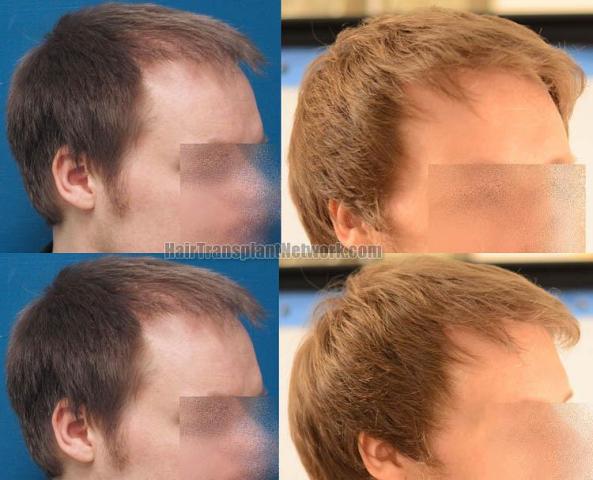 Hair transplantation surgery before and after images