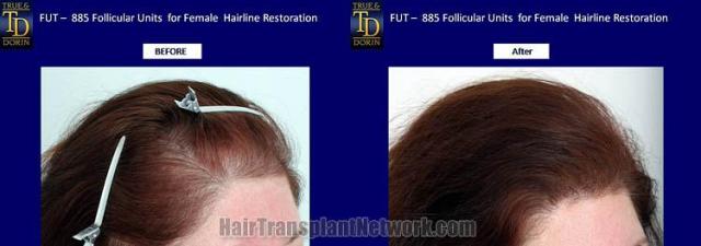 Hair transplantation surgery before and after images