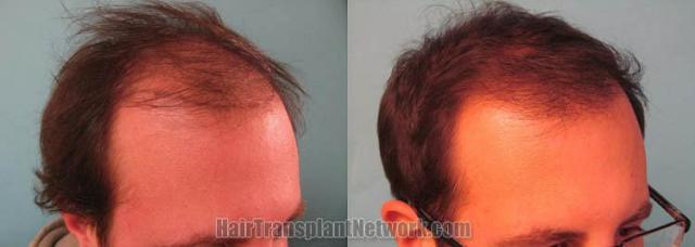 Hair restoration procedure before and after results