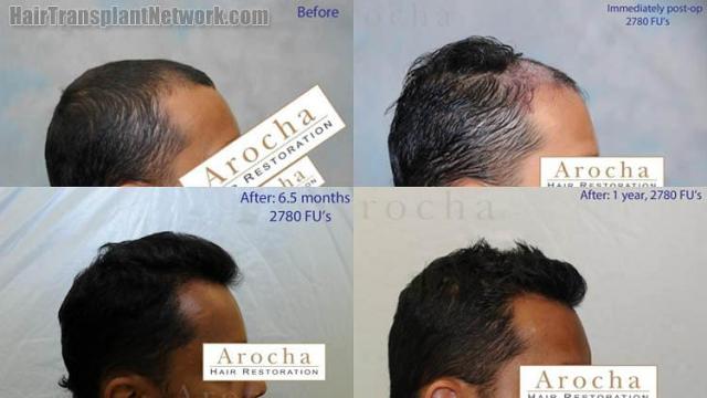 Hair transplantation surgery before and after images