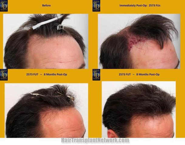 Hair transplantation surgery before and after images