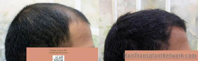 Hair transplantation surgery before and after images