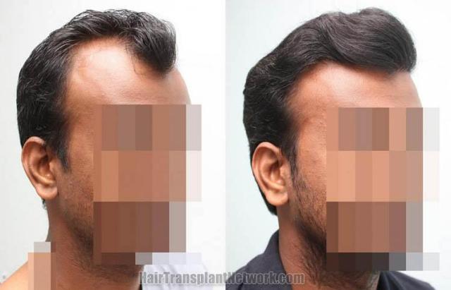 Hair transplantation surgery before and after images