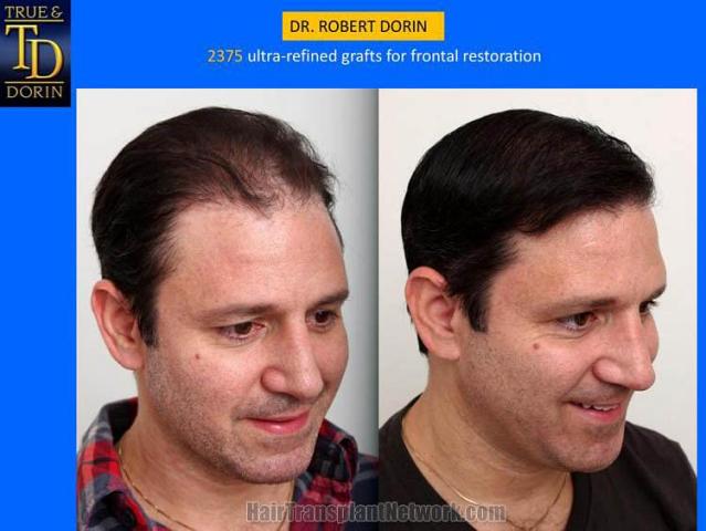 Hair transplantation surgery before and after pictures