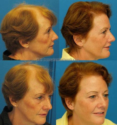 Hair transplantation surgery before and after pictures