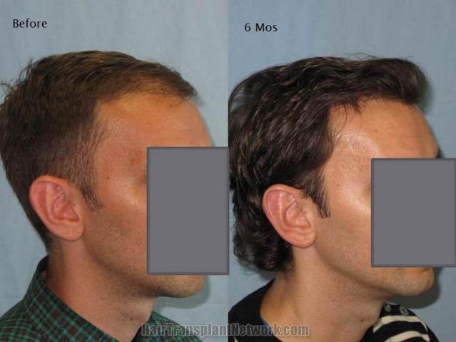 Hair transplantation surgery before and after photos