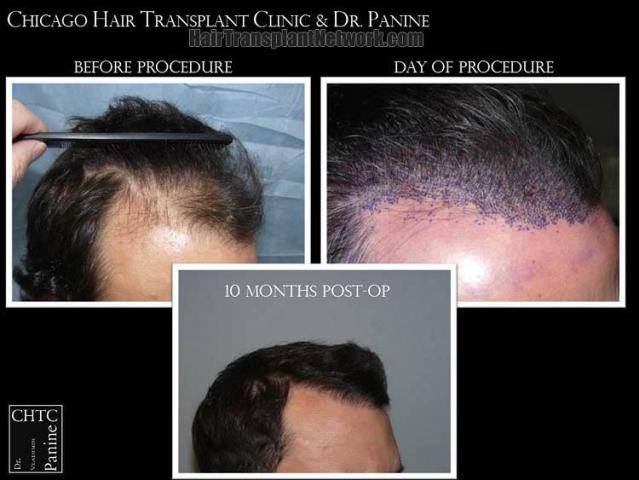 Hair restoration procedure before and after results