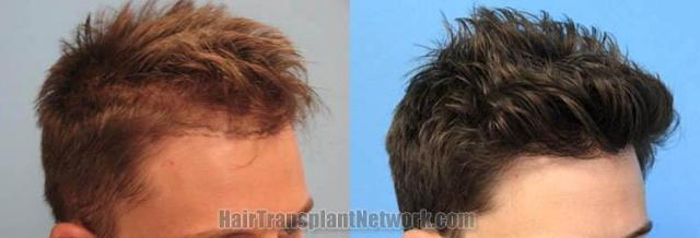 Hair transplantation surgery before and after images