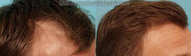 Hair transplantation surgery before and after images