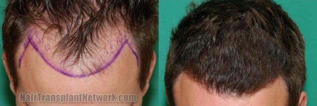 Top view before and after hair restoration results