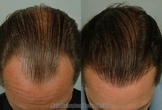 Hair transplantation surgery before and after photos