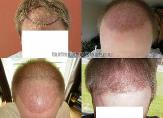 Hair transplantation surgery before and after photos