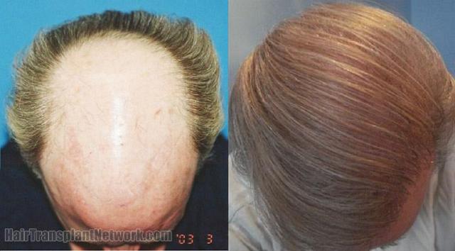 Hair transplantation surgery before and after pictures