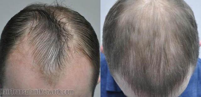 Before and after hair transplantation result photographs