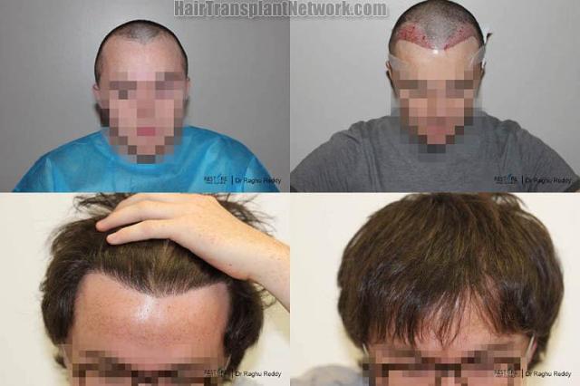 Hair transplantation surgery before and after photos