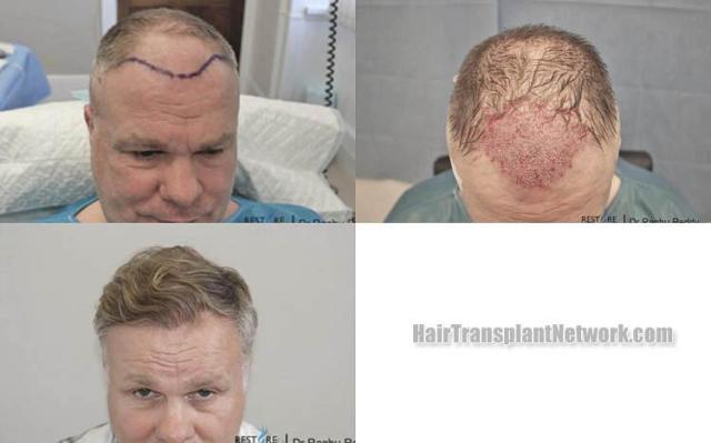 Hair restoration procedure before and after results