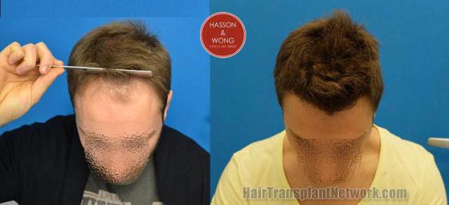 Before and after hair transplant procedure images