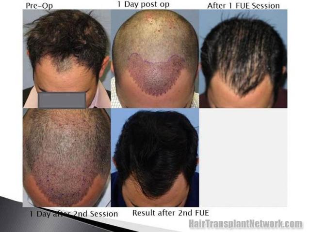 Hair transplantation surgery before and after photos