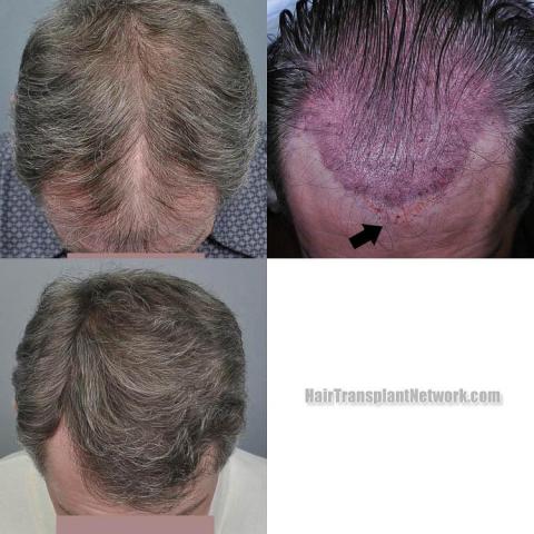 Hair transplantation surgery before and after images