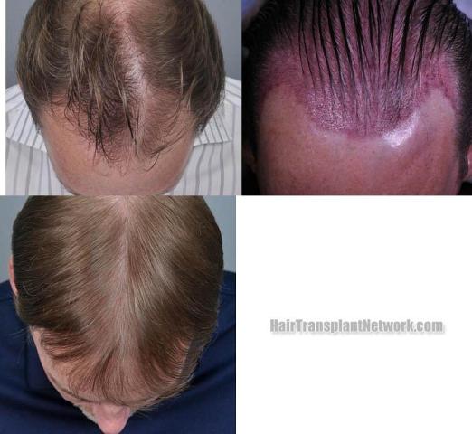 Hair transplantation surgery before and after images