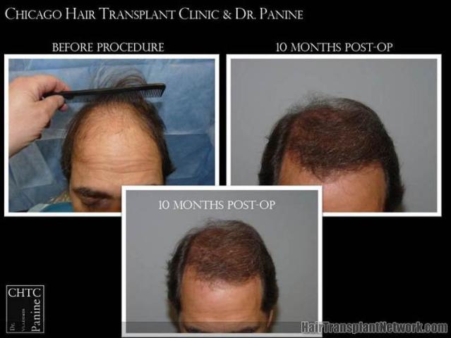 Hair restoration procedure before and after results