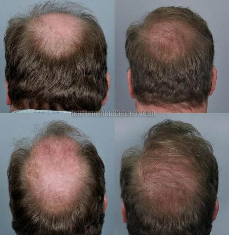 Hair restoration procedure before and after pictures