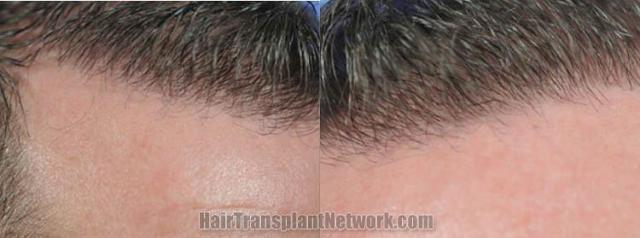 Hair transplant surgery before and after pictures