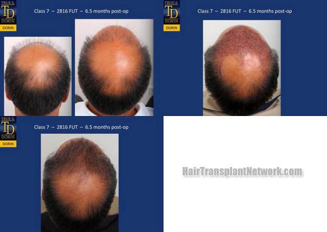 Back view before and after hair transplantation photos