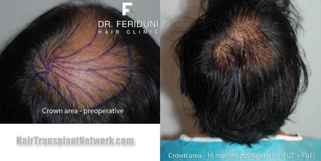 Hair transplantation surgery before and after pictures