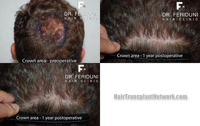 Hair transplantation surgery before and after pictures