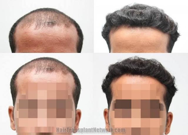 Hair restoration procedure before and after pictures