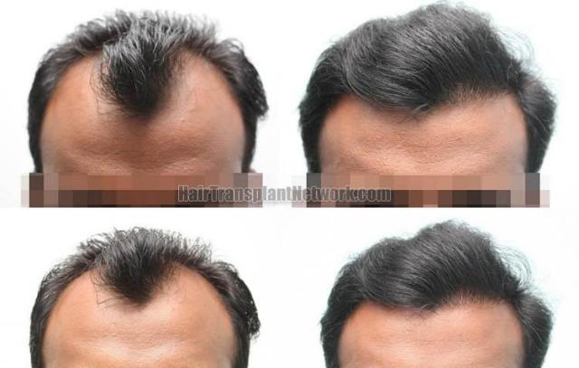 Hair restoration procedure before and after results