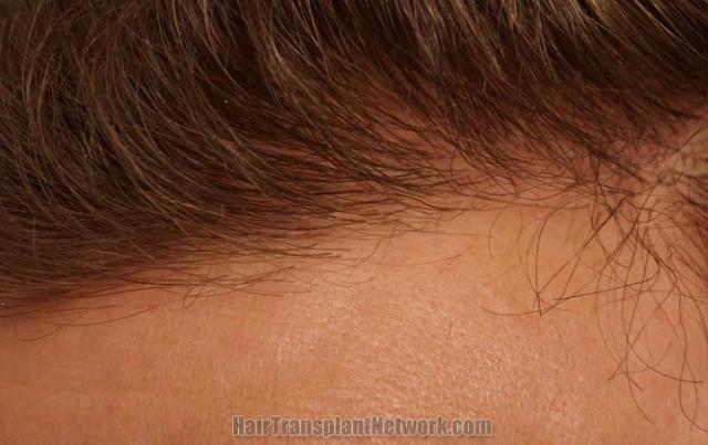 Hair restoration procedure before and after pictures