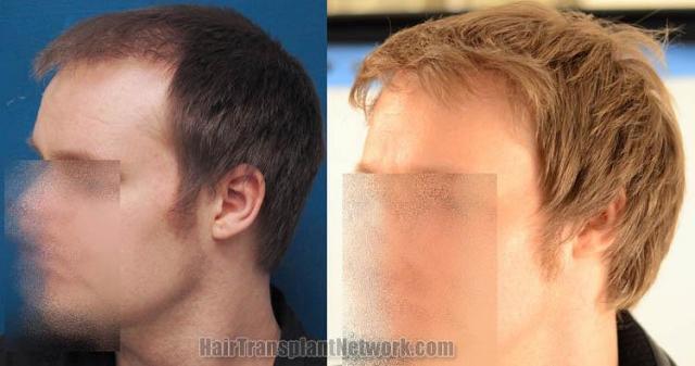 Hair transplantation surgery before and after pictures