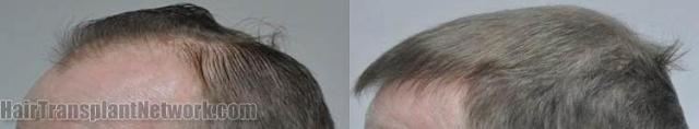 Hair transplantation surgery before and after photos