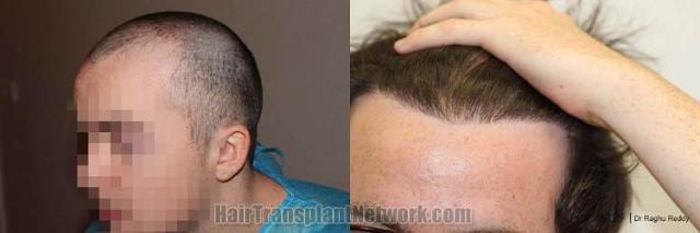 Hair transplantation surgery before and after pictures