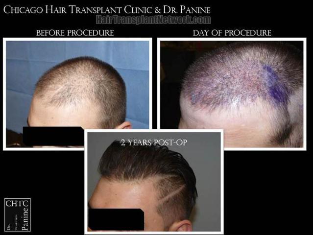 Hair transplantation surgery before and after images