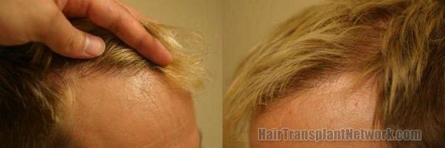 Right and left hairline closeups after hair transplant