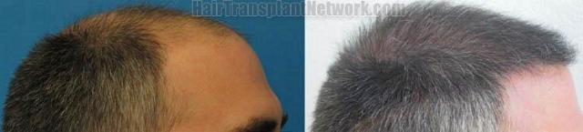 Right view photos showing hair transplant results