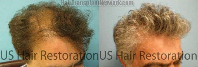 Right view - Hair replacement procedure photos