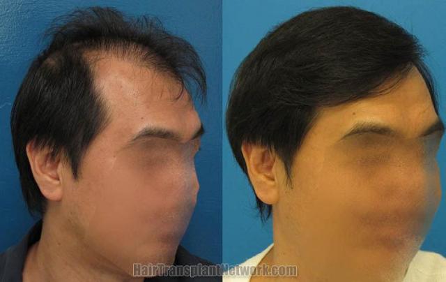 Hair restoration procedure before and after results