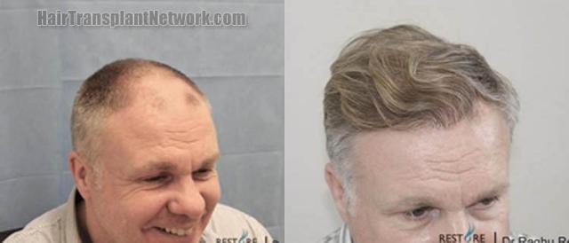 Hair transplantation surgery before and after photos