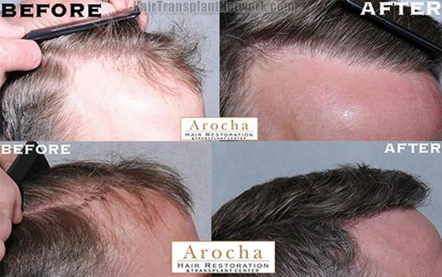 Hair transplantation surgery before and after photos